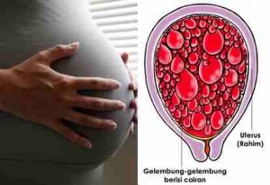 Informasi Mengenai Kehamilan Anggur Pada Ibu