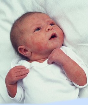 Cara Mencegah Bayi Yang Alergi